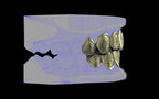 Custom Grillz & Tooth Caps - Dynasty Cut