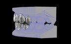 Custom Grillz & Tooth Caps - Dynasty Cut