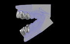 Custom Grillz & Tooth Caps - Dynasty Cut