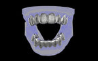 Custom Grillz & Tooth Caps - Dynasty Cut