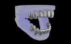Custom Grillz & Tooth Caps - Dynasty Cut