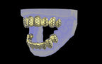 Custom Grillz / Tooth Caps - Funktion One