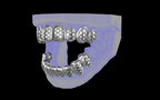 Custom Grillz / Tooth Caps - Funktion One