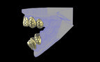 Custom Grillz / Tooth Caps - Funktion One