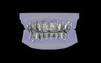 Custom Grillz / Tooth Caps - Graffiti Cut