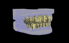 Custom Grillz / Tooth Caps - Graffiti Cut
