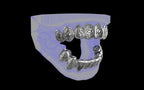 Custom Grillz / Tooth Caps - Graffiti Cut