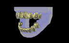Custom Grillz / Tooth Caps - Graffiti Cut