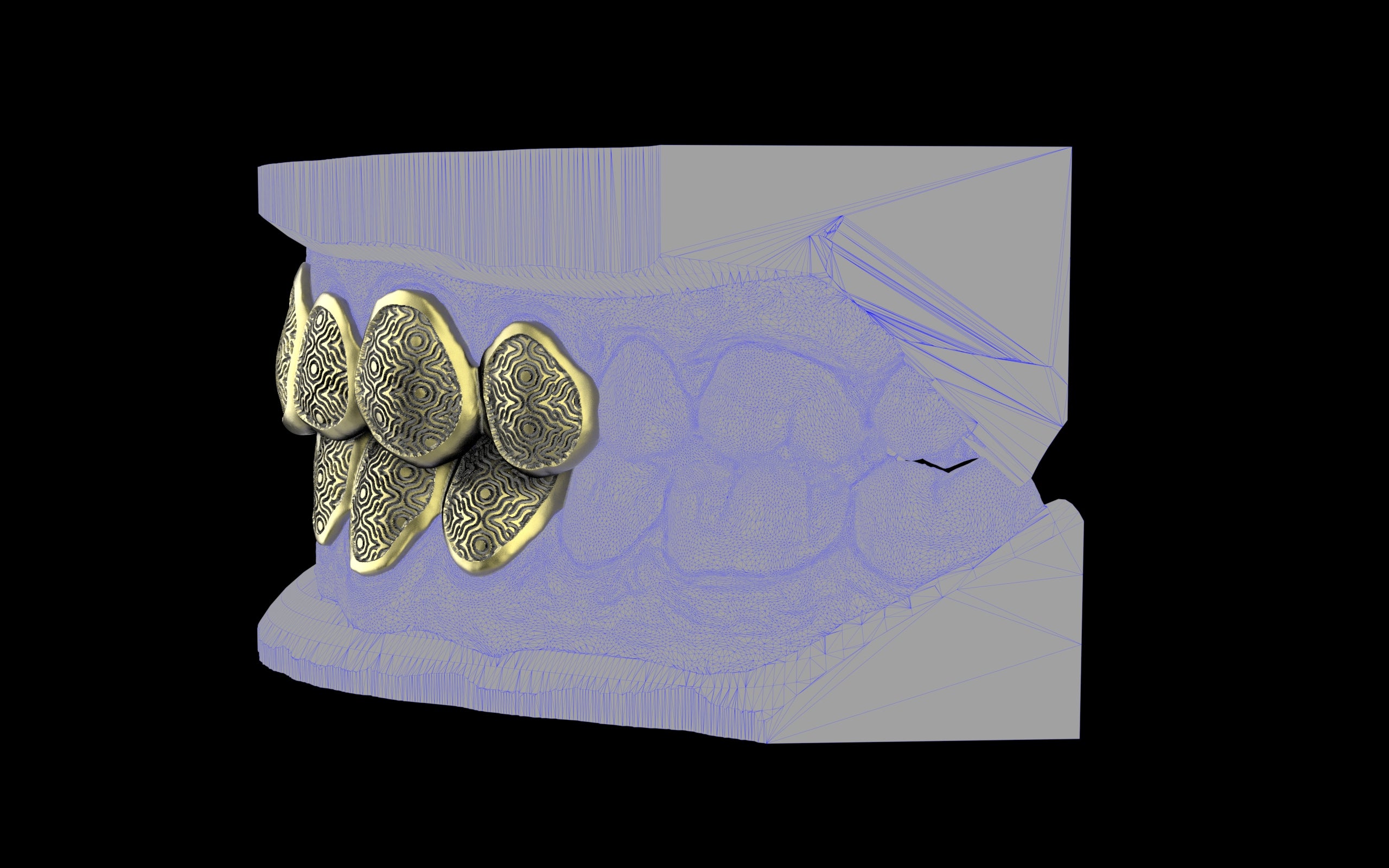 Custom Grillz / Tooth Caps - Puddled Cut