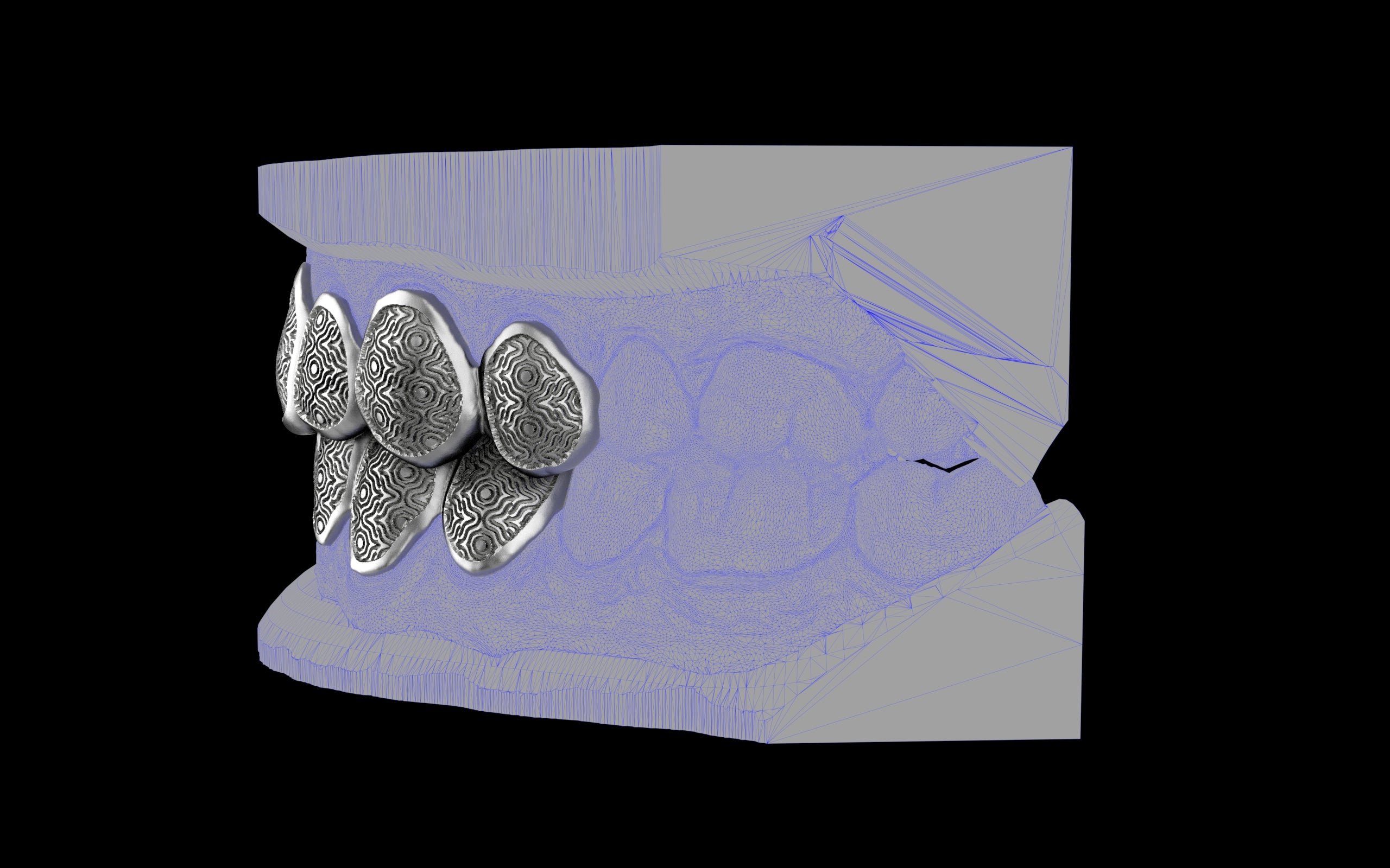 Custom Grillz / Tooth Caps - Puddled Cut