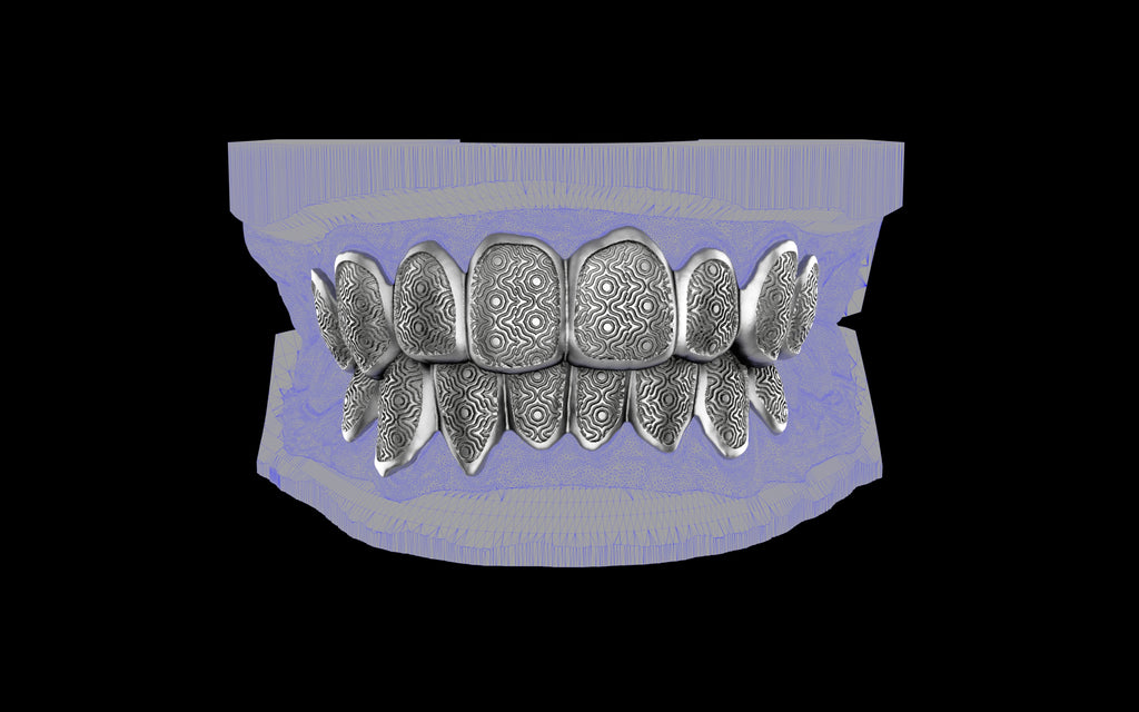 Custom Grillz / Tooth Caps - Puddled Cut
