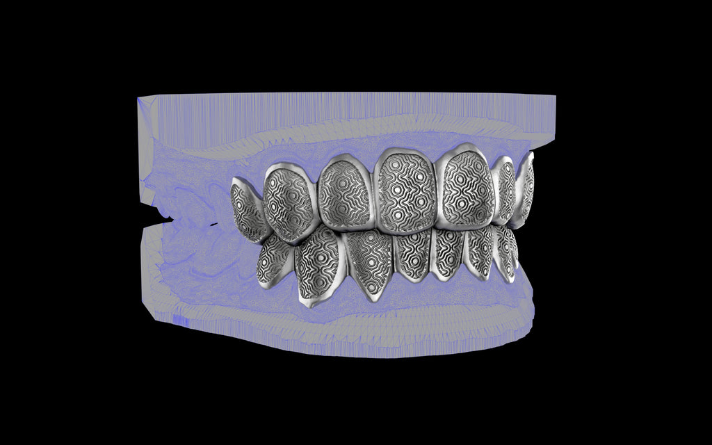 Custom Grillz / Tooth Caps - Puddled Cut