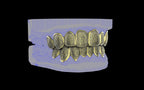 Custom Grillz / Tooth Caps - Puddled Cut