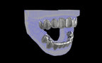 Custom Grillz / Tooth Caps - Puddled Cut