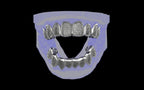 Custom Grillz / Tooth Caps - Puddled Cut