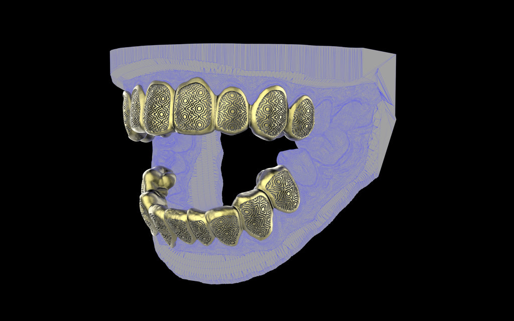 Custom Grillz / Tooth Caps - Puddled Cut
