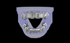 Custom Grillz / Tooth Caps - Fish Scale Cut
