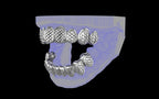 Custom Grillz / Tooth Caps - Fish Scale Cut